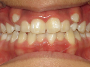 Braces Before and After Pictures Virginia Beach, VA