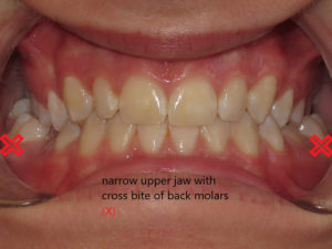 Braces Before and After Pictures in Virginia Beach, VA