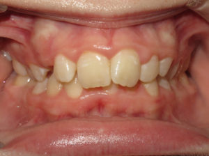 Braces Before and After Pictures in Virginia Beach, VA