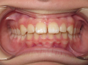 Invisalign Before and After Pictures in Virginia Beach, VA