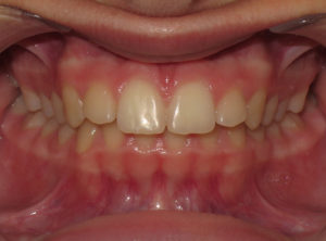 Invisalign Before and After Pictures in Virginia Beach, VA