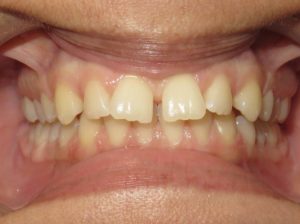 Braces Before and After Pictures in Virginia Beach, VA