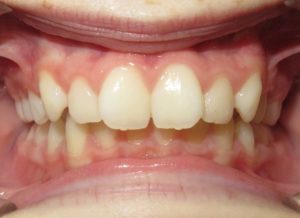 Braces Before and After Pictures in Virginia Beach, VA