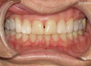 Invisalign Before and After Pictures in Virginia Beach, VA