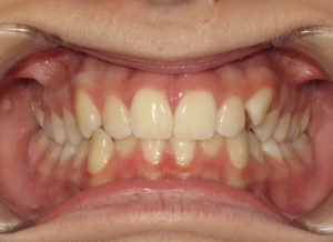 Invisalign Before and After Pictures Virginia Beach, VA