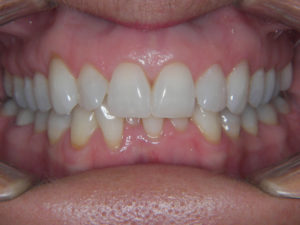 Invisalign Before and After Pictures Virginia Beach, VA