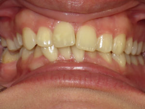 Invisalign Before and After Pictures Virginia Beach, VA