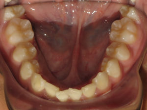 Invisalign Before and After Pictures Virginia Beach, VA