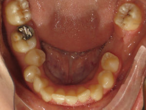 Invisalign Before and After Pictures in Virginia Beach, VA