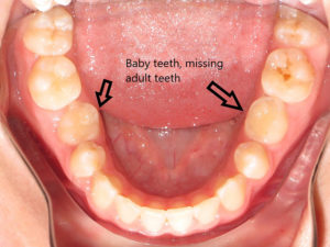 Braces Before and After Pictures in Virginia Beach, VA