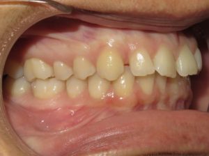 Braces Before and After Pictures in Virginia Beach, VA