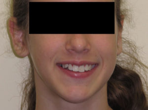 Braces Before and After Pictures Virginia Beach, VA