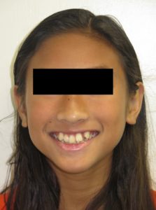 Braces Before and After Pictures Virginia Beach, VA