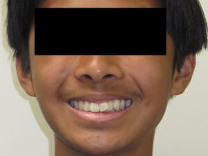 Invisalign Before and After Pictures in Virginia Beach, VA