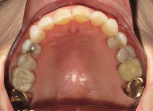 Invisalign Before and After Pictures in Virginia Beach, VA