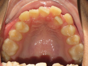 Braces Before and After Pictures Virginia Beach, VA