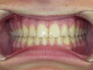 Braces Before and After Pictures Virginia Beach, VA