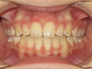 Braces Before and After Pictures Virginia Beach, VA