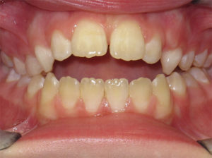 Braces Before and After Pictures Virginia Beach, VA