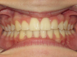 Braces Before and After Pictures Virginia Beach, VA