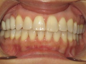 Invisalign Before and After Pictures in Virginia Beach, VA