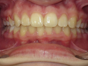 Braces Before and After Pictures Virginia Beach, VA