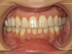 Invisalign Before and After Pictures in Virginia Beach, VA