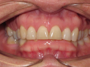 Invisalign Before and After Pictures Virginia Beach, VA