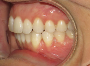 Invisalign Before and After Pictures Virginia Beach, VA