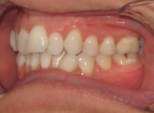 Invisalign Before and After Pictures Virginia Beach, VA