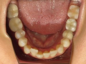 Invisalign Before and After Pictures in Virginia Beach, VA