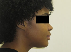 Surgery Before and After Pictures in Virginia Beach, VA