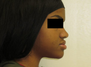 Surgery Before and After Pictures in Virginia Beach, VA