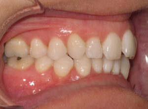 Invisalign Before and After Pictures Virginia Beach, VA