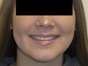 Braces Before and After Pictures Virginia Beach, VA