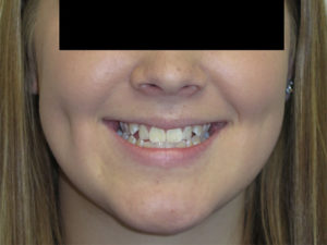 Braces Before and After Pictures Virginia Beach, VA