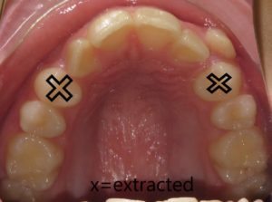 Braces Before and After Pictures Virginia Beach, VA