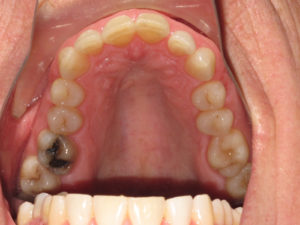 Invisalign Before and After Pictures Virginia Beach, VA