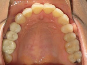 Invisalign Before and After Pictures in Virginia Beach, VA